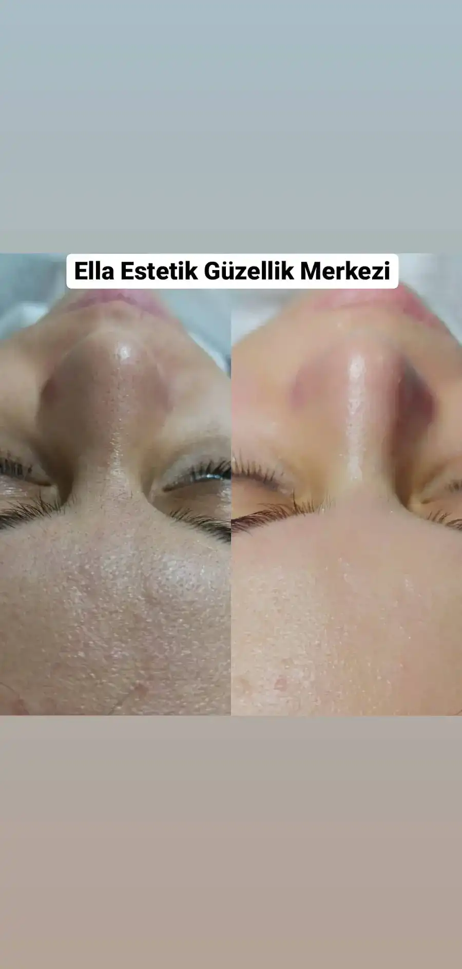 Şereflikoçhisar Ella Estetik ve Güzellik Merkezi fotoğraf 2