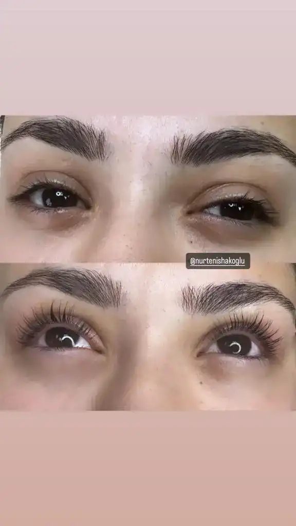 Nurten İshakoğlu Güzellik Merkezi - Gaziantep Lazer Epilasyon - Kalıcı Makyaj - Cilt Bakımı - Dermapen fotoğraf 2
