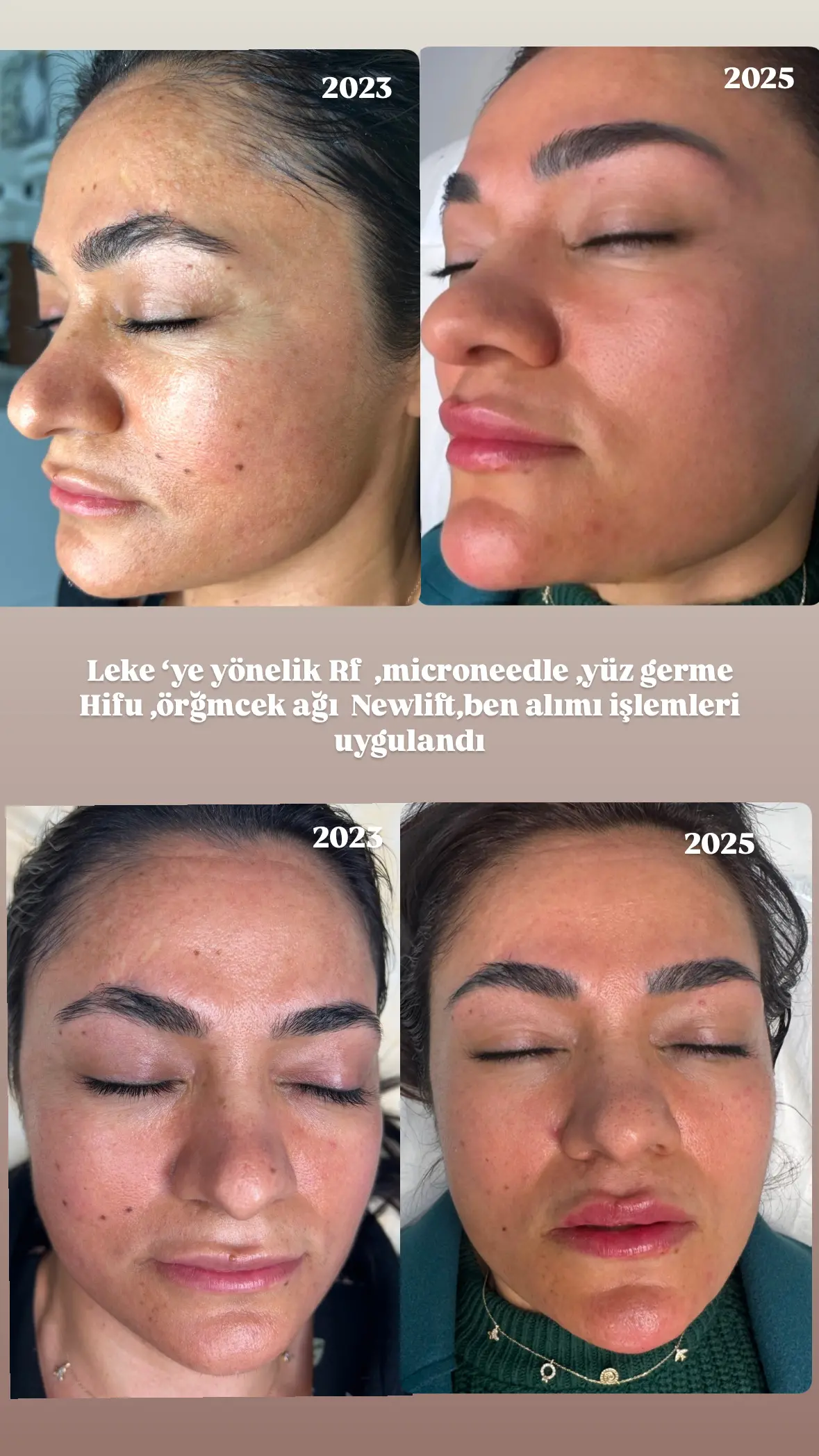 Nurten İshakoğlu Güzellik Merkezi - Gaziantep Lazer Epilasyon - Kalıcı Makyaj - Cilt Bakımı - Dermapen fotoğraf 3