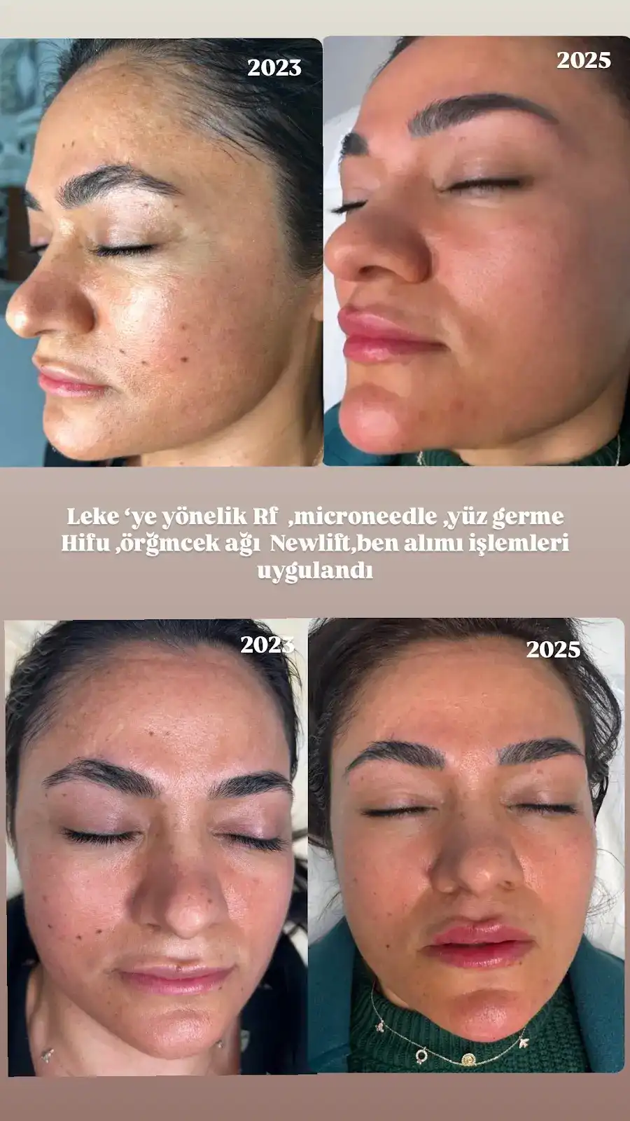 Nurten İshakoğlu Güzellik Merkezi - Gaziantep Lazer Epilasyon - Kalıcı Makyaj - Cilt Bakımı - Dermapen fotoğraf 3