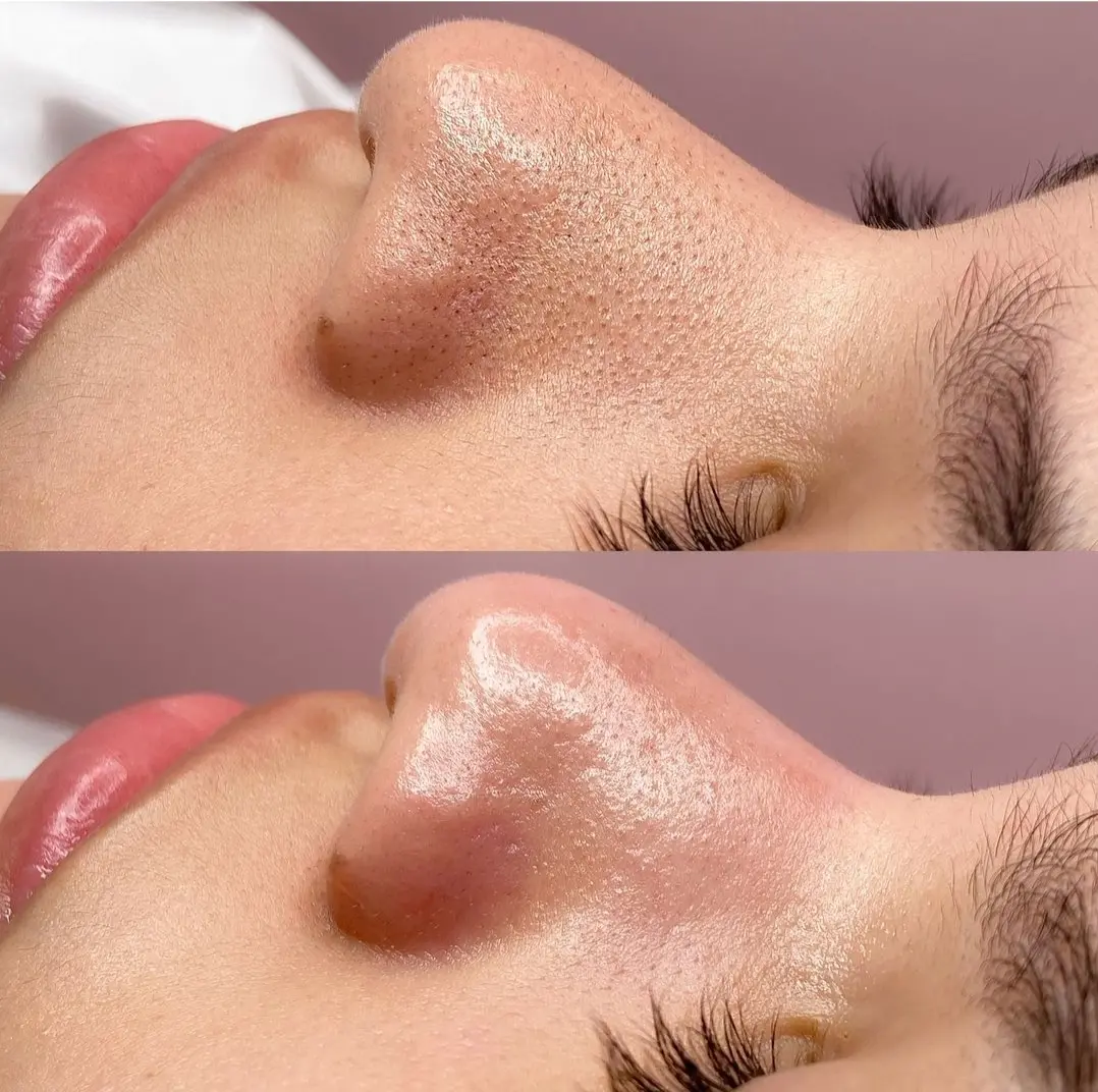 Catmosfer Güzellik Stüdyosu / Kadıköy Lazer Epilasyon / Kadıköy Hydrafacial Cilt Bakımı / Kadıköy Buz Lazer fotoğraf 3
